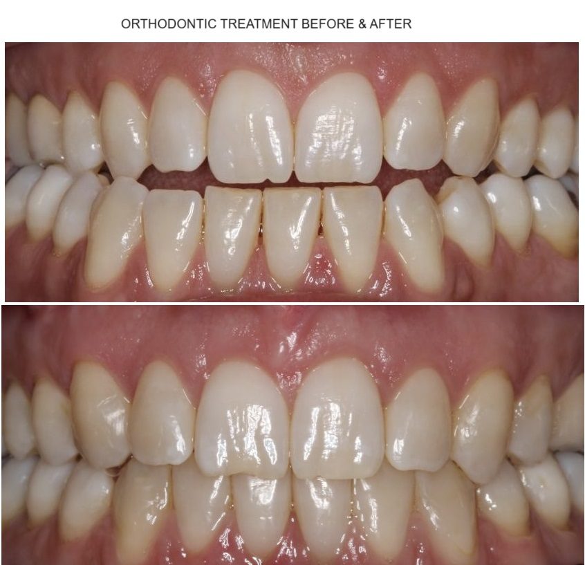 علاج تقويم الأسنان قبل وبعد الصورة 2