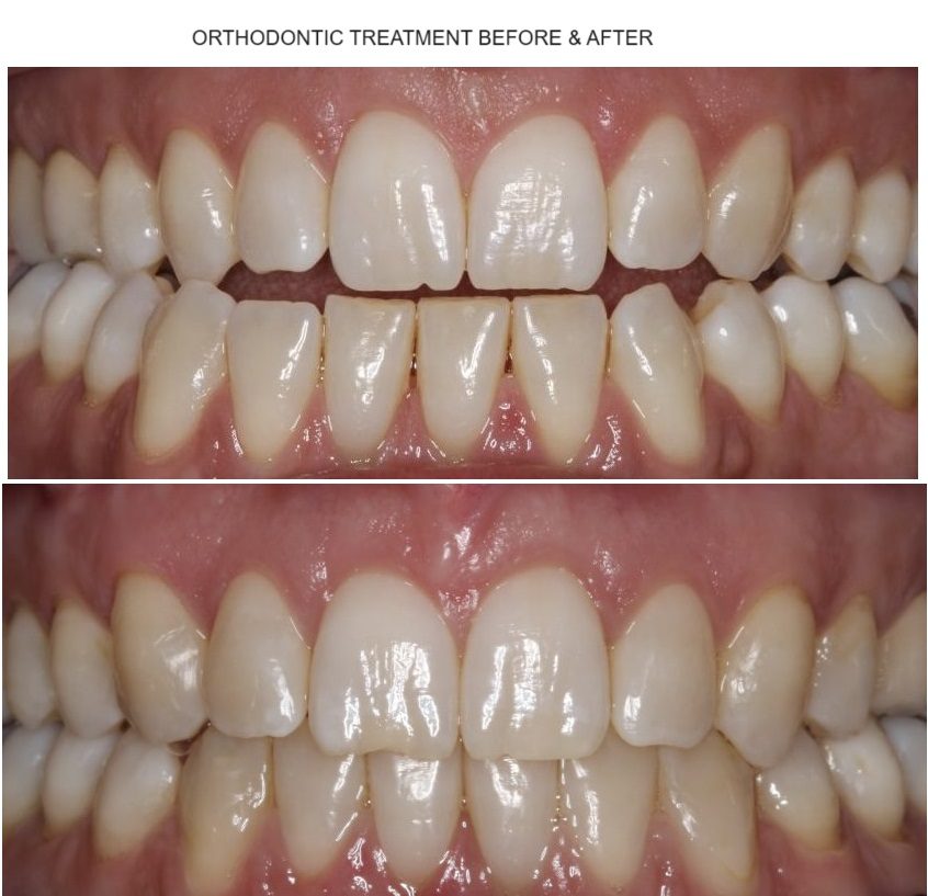 Ορθοδοντική θεραπεία πριν & μετά εικόνα 2