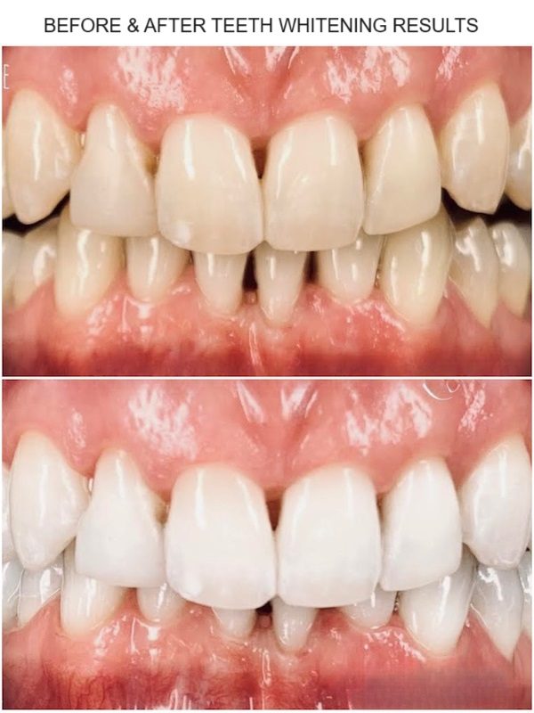 blanchiment des dents à Dubaï résultats avant et après la photo du patient réel 1