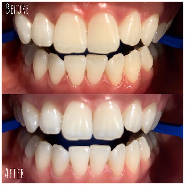 blanchiment des dents à Dubaï résultats avant et après la photo du patient réel 2
