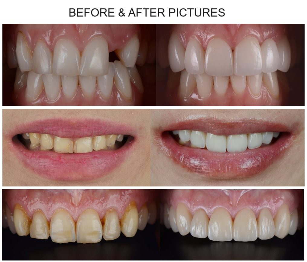 Coronas y puentes dentales en Dubai, Emiratos Árabes Unidos, imágenes de antes y después del tratamiento