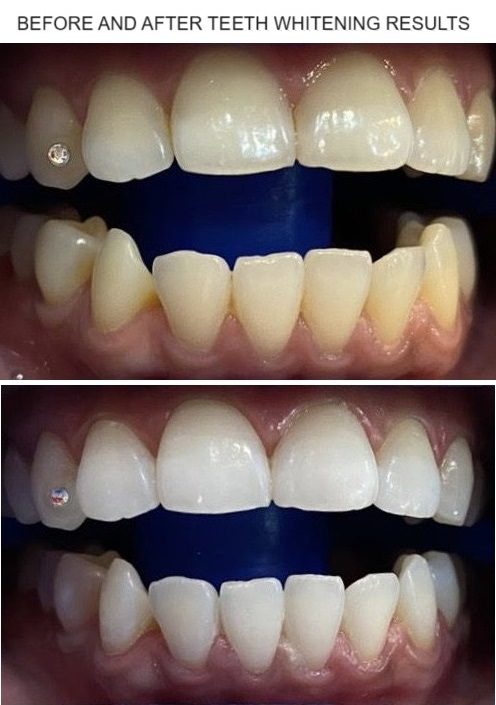 Blanqueamiento dental en Dubai, Emiratos Árabes Unidos, antes y después de los resultados del tratamiento.