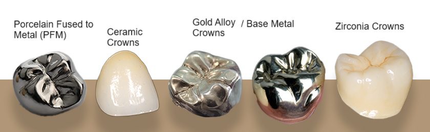 Types of Dental Crowns in Dubai UAE