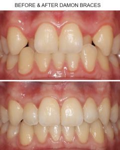 before & after damon braces pic 1