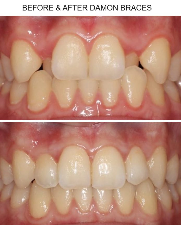 before & after damon braces pic 1