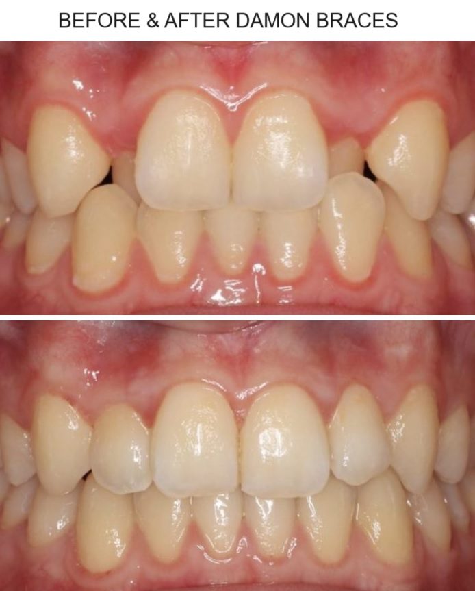 قبل وبعد تقويم دامون الصورة 1