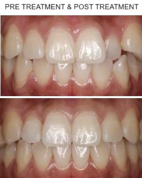 damon braces pre treatment & post treatment pic