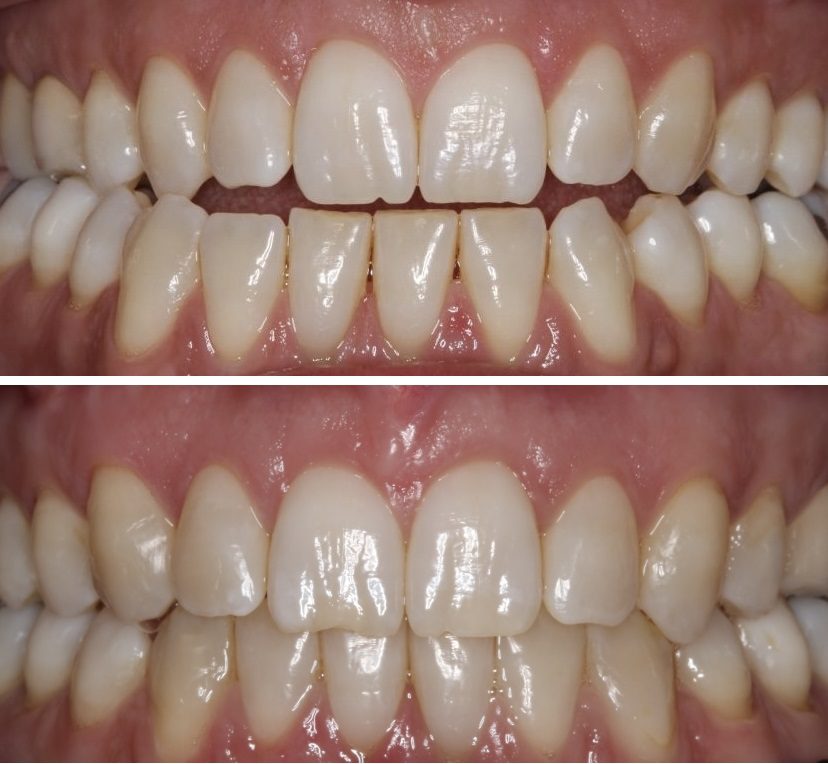 invisalign en dubai paciente 2 antes y después de los resultados del tratamiento