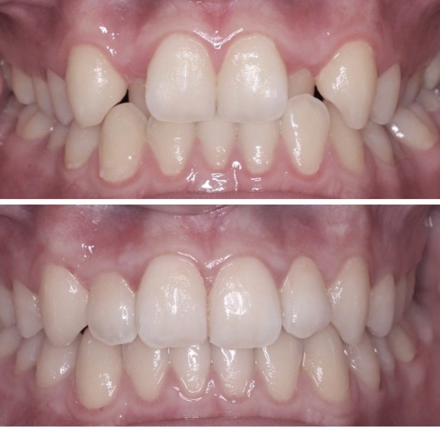 invisalign en dubai paciente 3 antes y después de los resultados del tratamiento