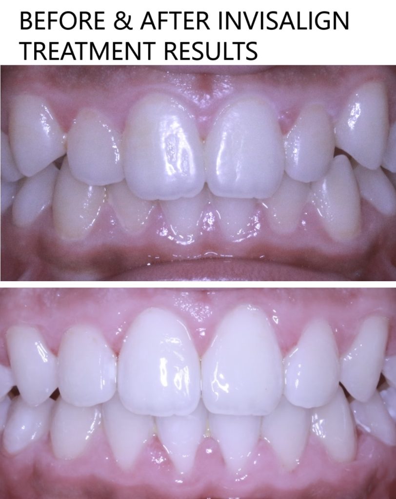 invisalign en dubai paciente 1 antes y después de los resultados del tratamiento