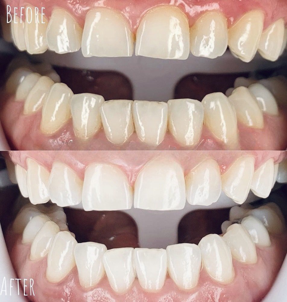 تبييض الأسنان في دبي نتائج قبل وبعد الصورة الفعلية للمريض 3