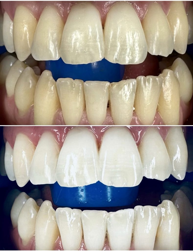 risultati dello sbiancamento dei denti a Dubai prima e dopo la foto reale del paziente 4