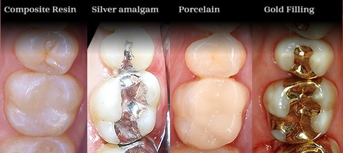 types of dental tooth filling in Dubai UAE